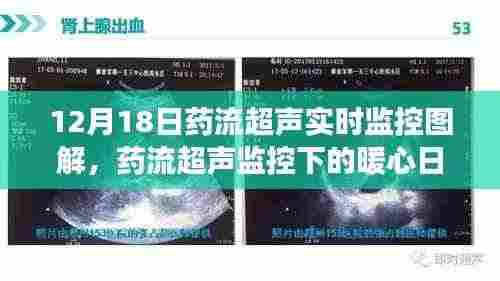 药流超声实时监控下的温馨时光,暖心日常与友共度时刻